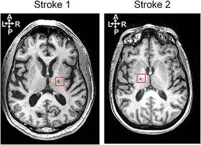 Dynamic Information Flow Based on EEG and Diffusion MRI in Stroke: A Proof-of-Principle Study